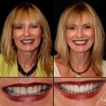 Smile Facelift NYC 2