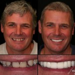 Smile Makeover NYC 3