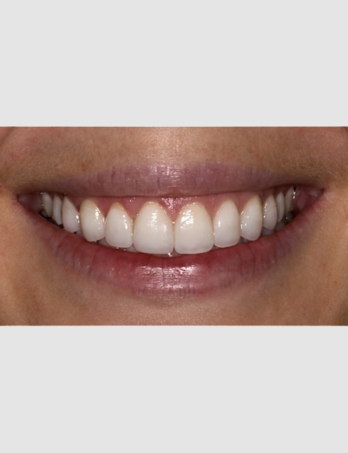 Patient Teeth