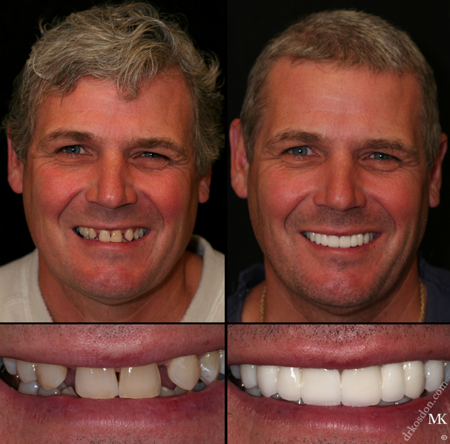 Smile Makeover Manhattan New York City NY Smile Makeover Manhattan New York City NY