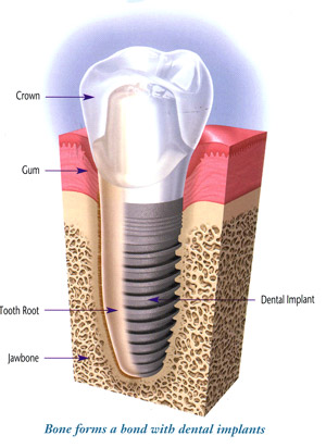 Dental Implants