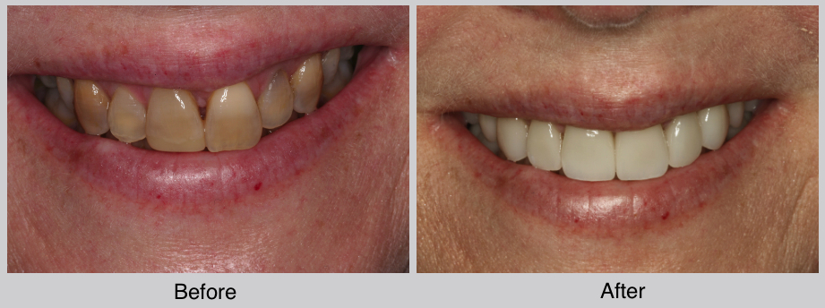 Smile Makeover Results