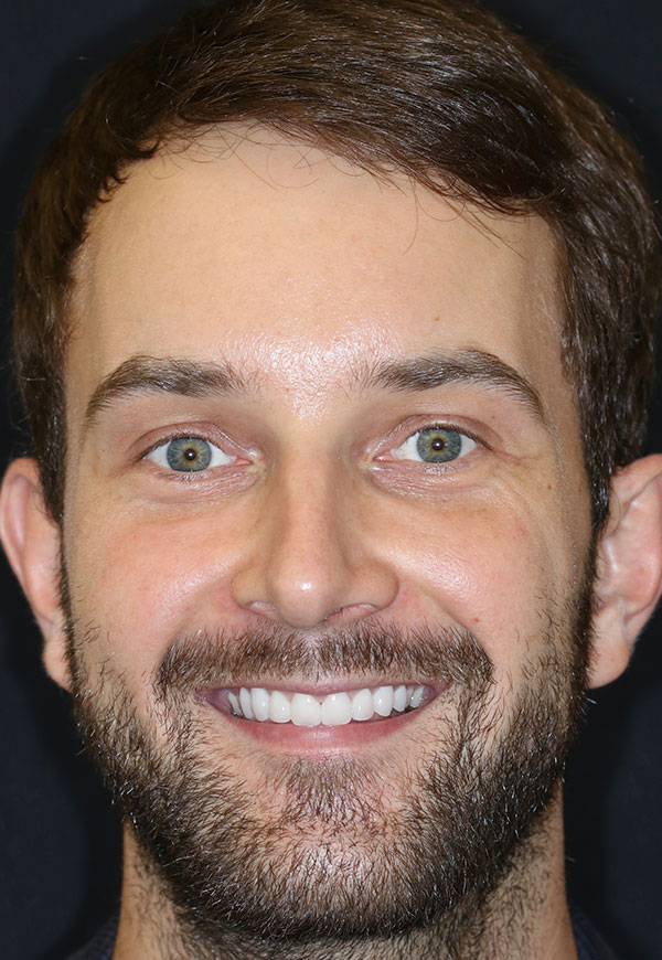 Male patient of Dr. Kosdon with proportionally sized, perfectly spaced teeth following porcelain veneers placement