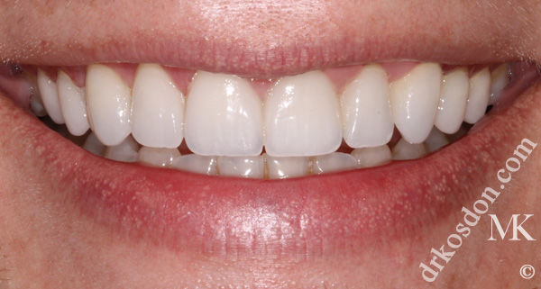 Teeth After