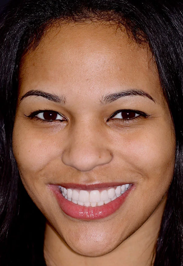 Female patient of Dr. Kosdon with brilliantly white, straight smile after porcelain veneers