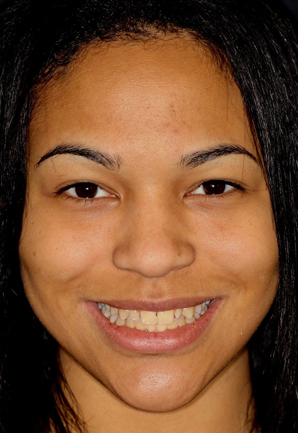 Female patient of Dr. Kosdon with discolored, uneven teeth before porcelain veneers