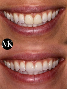 Cosmetic Dentistry Results