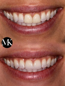Cosmetic Dentistry Results