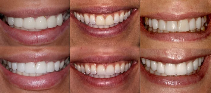 Cosmetic and  Restorative Dental Work Results