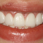 Teeth After