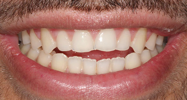 Teeth Before