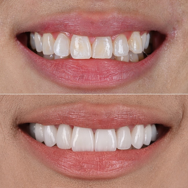 Natural-Looking Veneers NYC - Smile Before and After 1