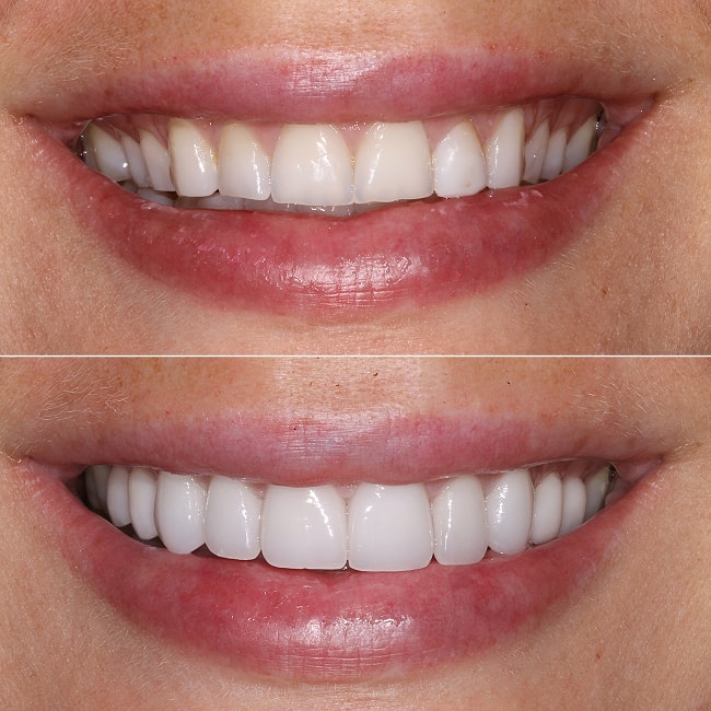 Minimal Preparation Veneers NYC - Smile Before and After 2