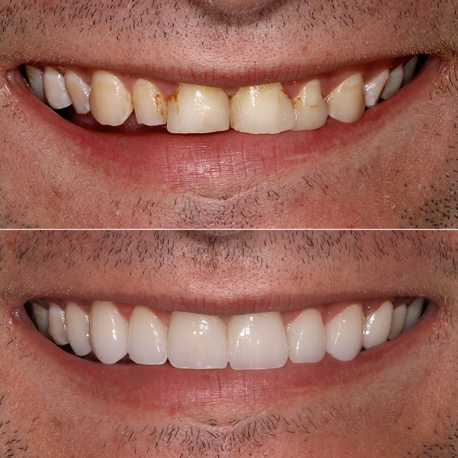 Minimal Prep Veneers NYC - Smile Before and After 3