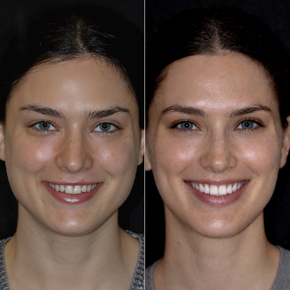 Porcelain Veneers NYC - Female Patient Full Face Before and After 1