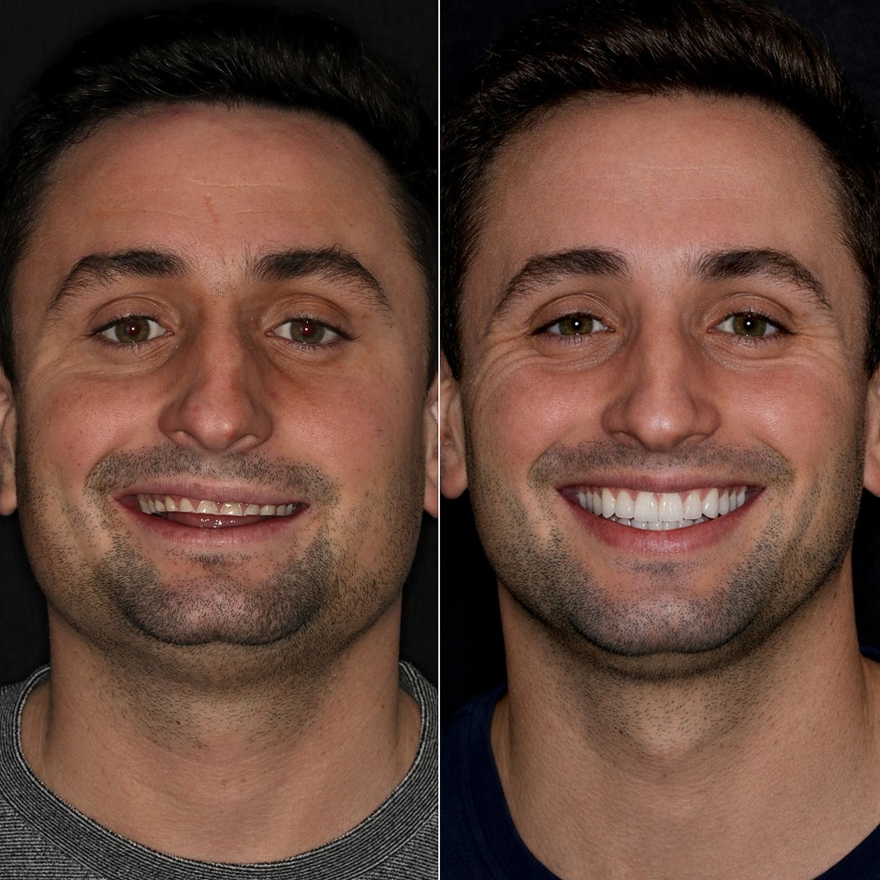 Porcelain Veneers NYC - Male Patient Full Face Before and After 2