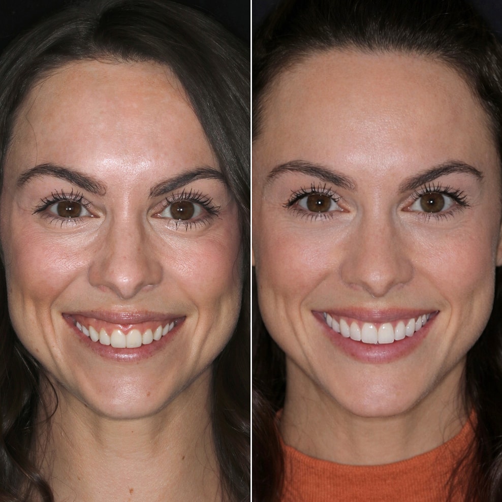 Veneers NYC - Female Patient Full Face Before and After 3