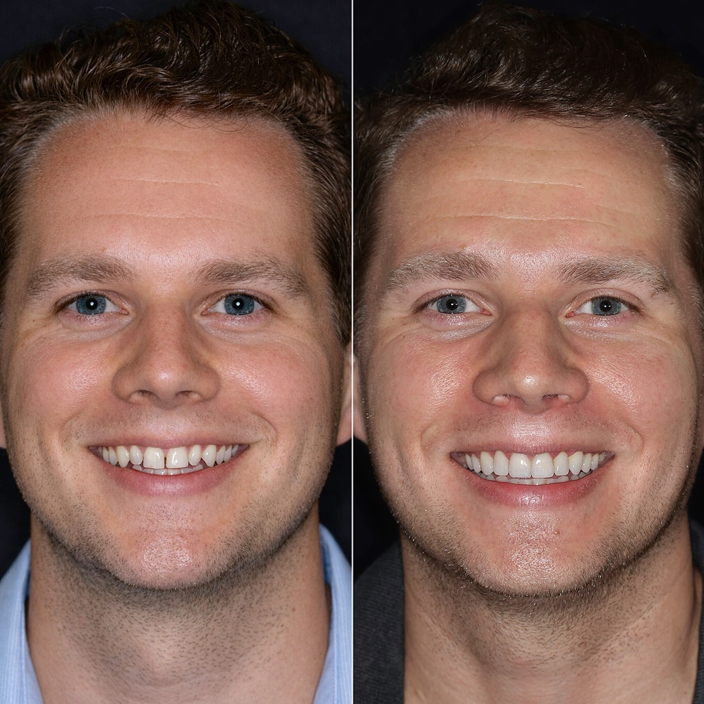 Veneers NYC - Male Patient Full Face Before and After 4