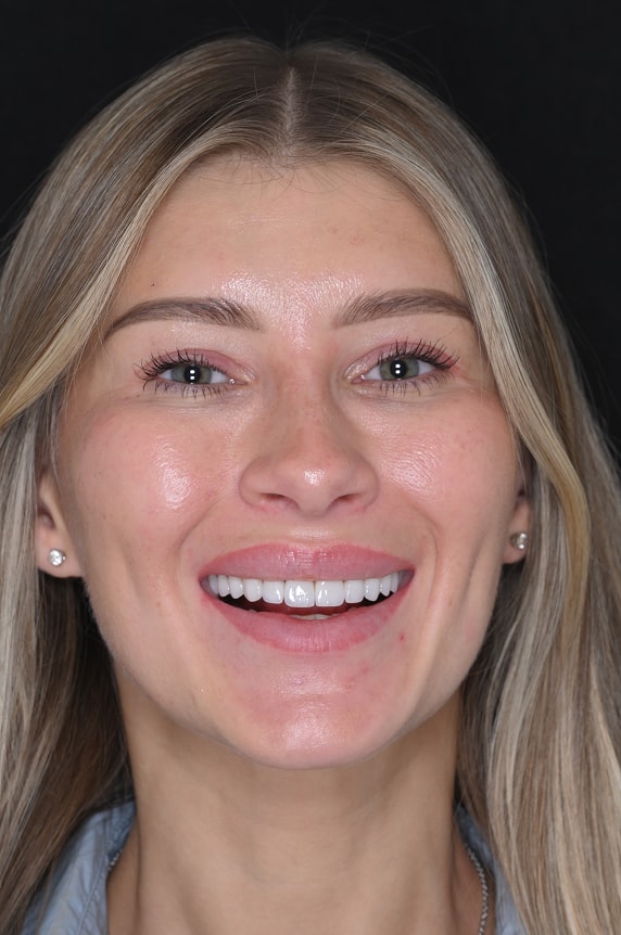 New York City Smile Design and Veneers - Female After 1
