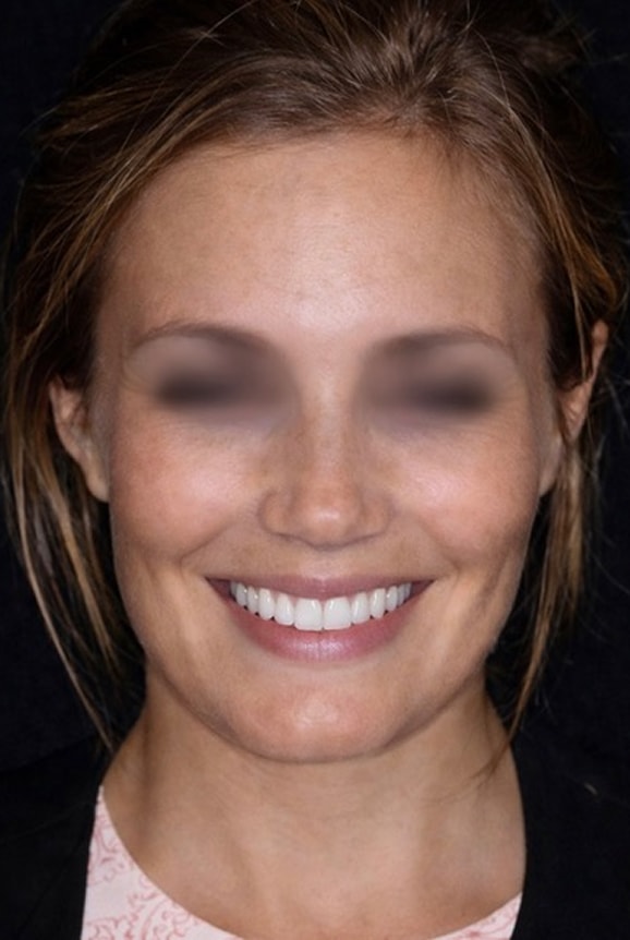 Smile Design NYC - Female After 2