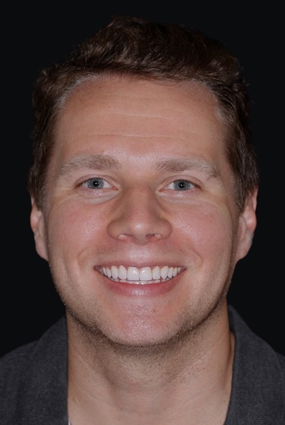 Veneers and Smile Design NYC - Male After 1