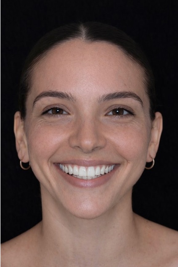 New York City Smile Design - Female After 3