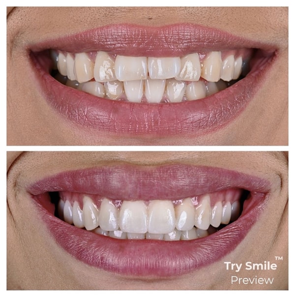 Veneers Preview Example Before and After