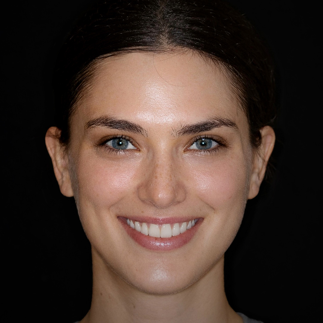 Natural-Looking Porcelain Veneers
