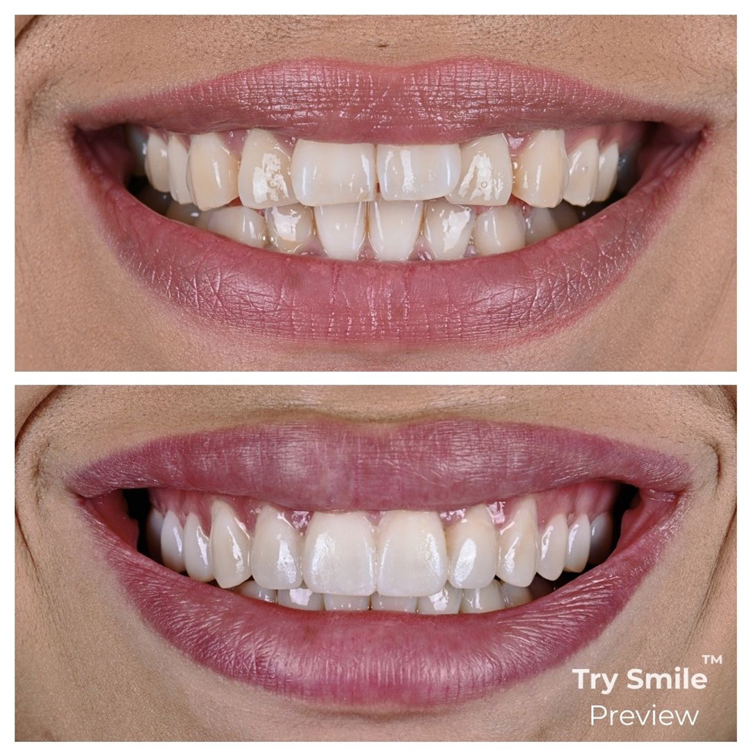 Try Smile