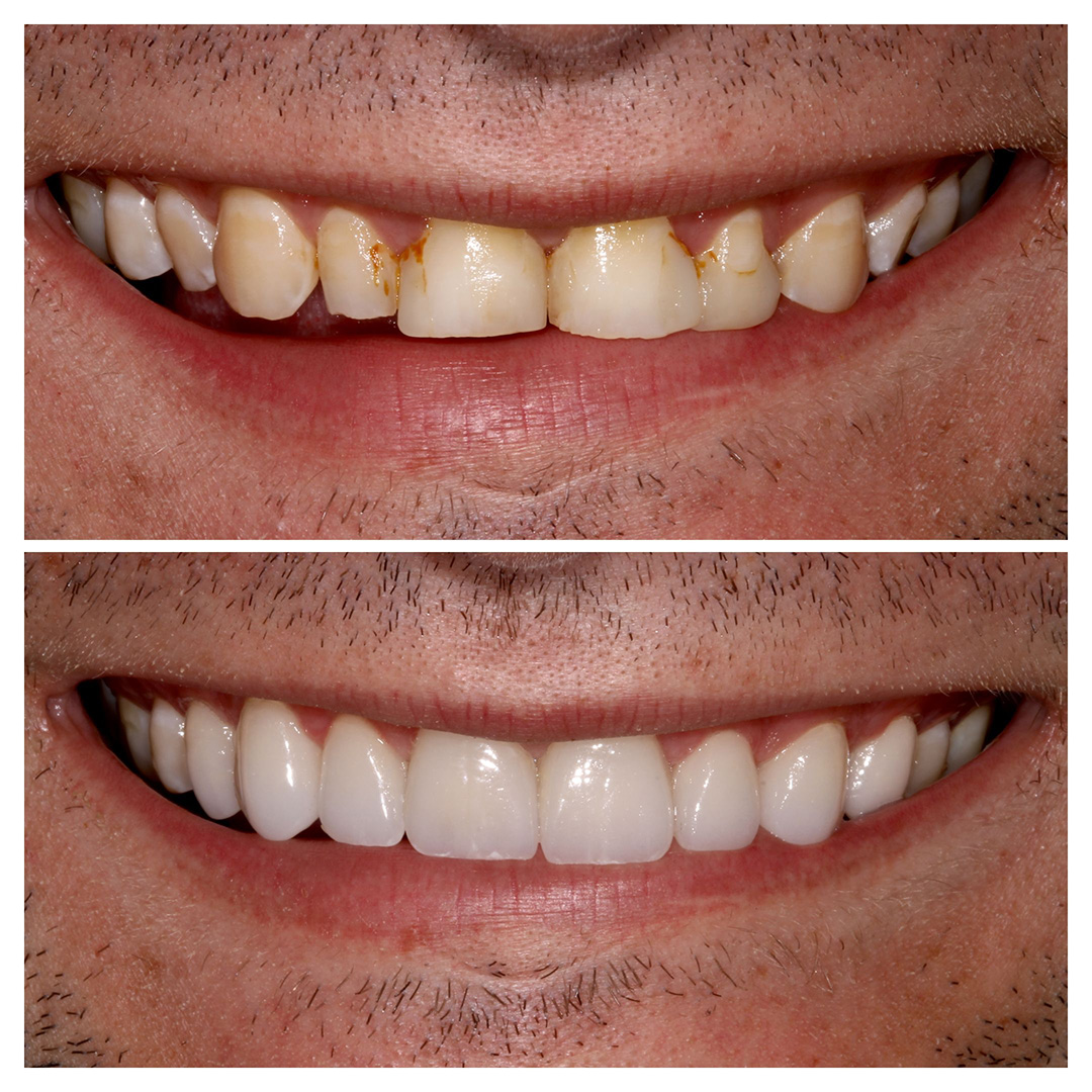 Veneers vs. Bonding vs. Crowns