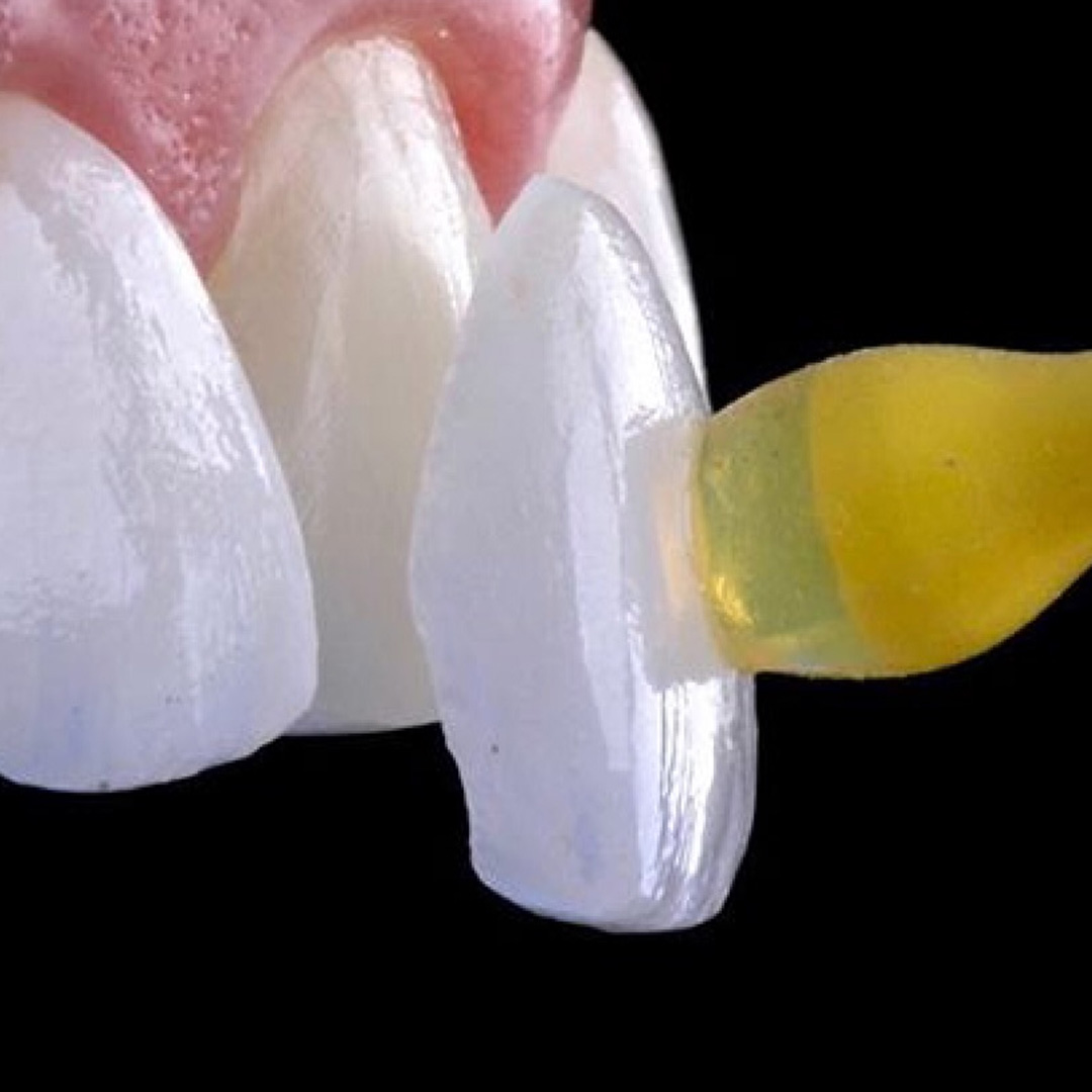 Minimal Prep Porcelain Veneers