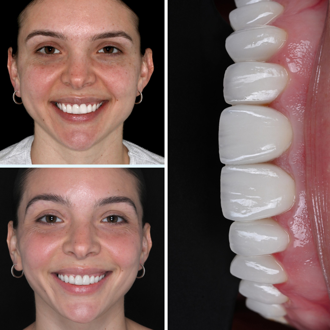 Veneer Redesign & Second Opinions
