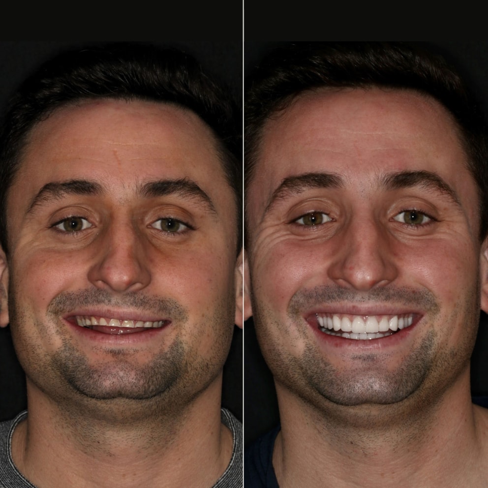 Porcelain Veneers NYC - Male Patient Full Face Before and After 2