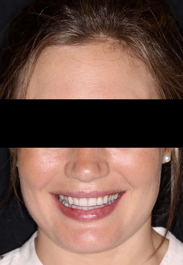 porcelain veneers before