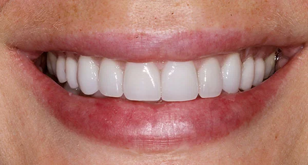 porcelain veneers after