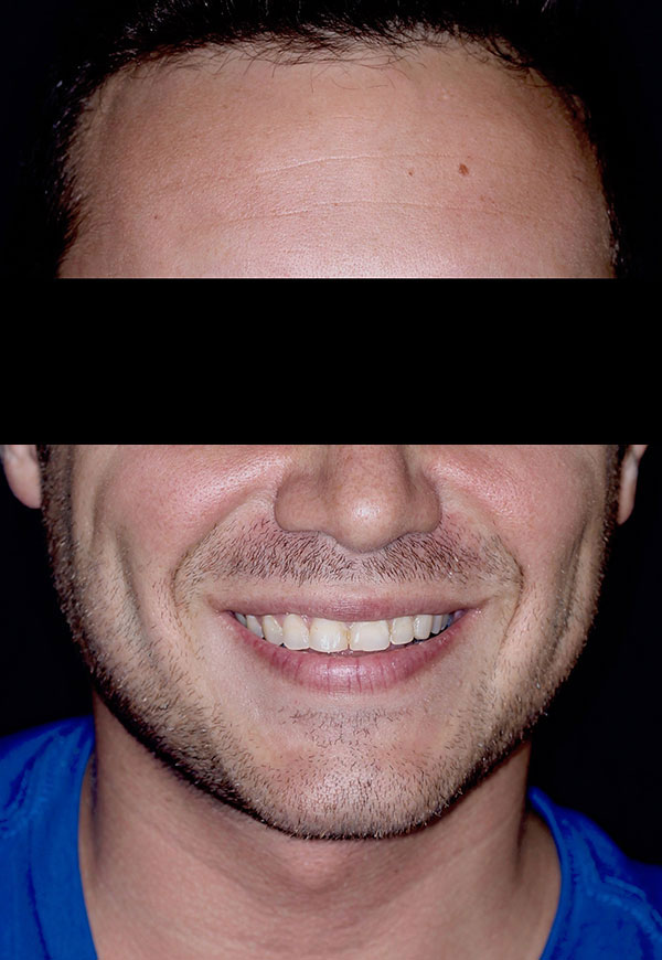 porcelain veneers before