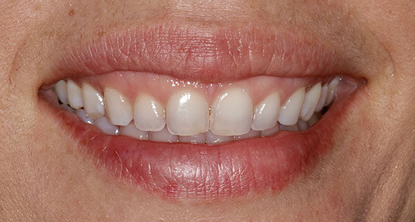 porcelain veneers before