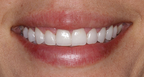 porcelain veneers after