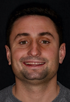 Porcelain Veneers Before