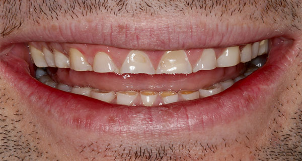 porcelain veneers before