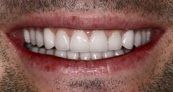 porcelain veneers after