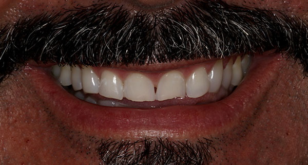 Porcelain Veneers Photos NYC - Smile Before Men Patient 38
