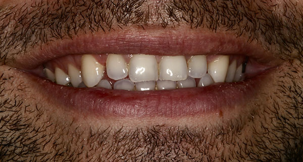 porcelain veneers before