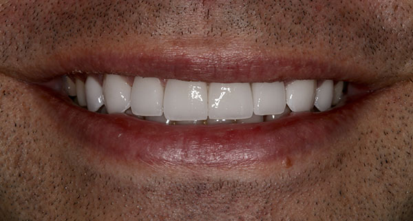 porcelain veneers after