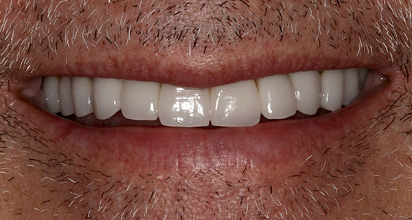 porcelain veneers after