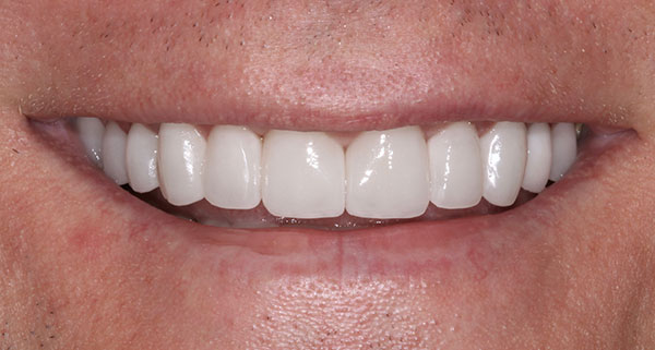 porcelain veneers after