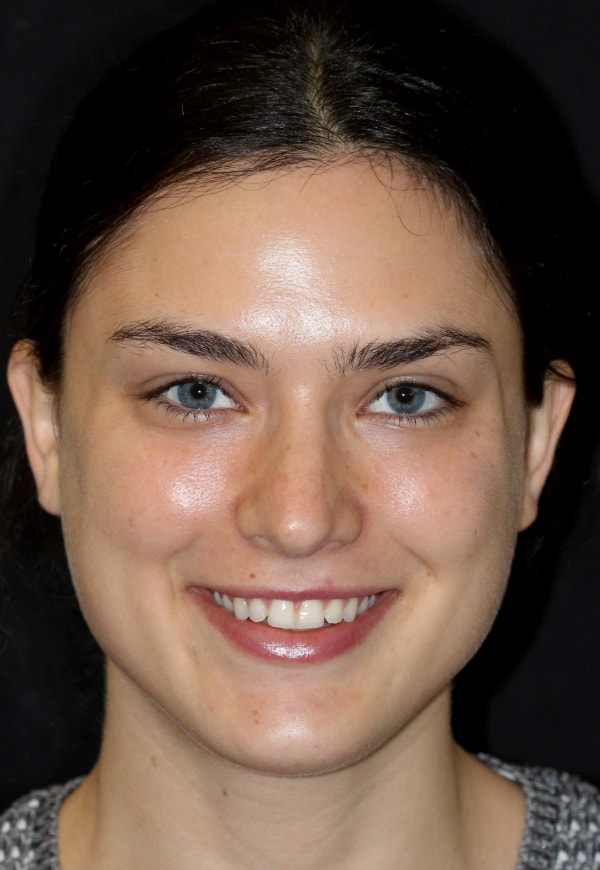 Porcelain Veneers Photos NYC - Portrait1 Before Women Patient 108