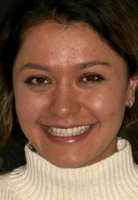 Porcelain Veneers Before