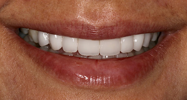 porcelain veneers after