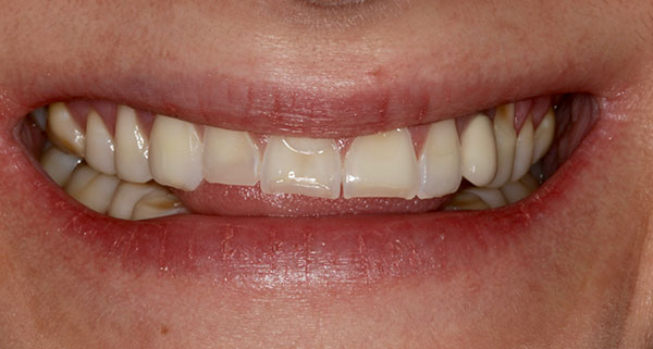 porcelain veneers before